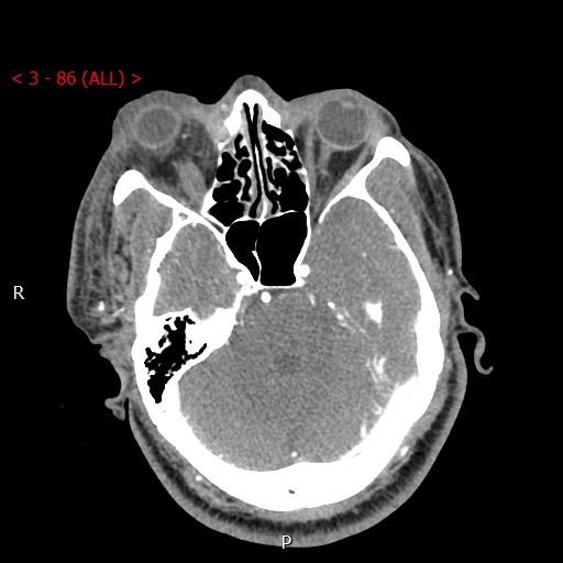 Caroticocavernous fistula (Radiopaedia 42346-45457 B 17).jpg