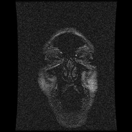 Carotid arterial dissection with acute cerebral infarction (Radiopaedia 26636-26784 MRV 149).jpg