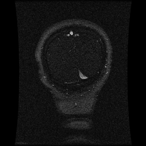 Carotid arterial dissection with acute cerebral infarction (Radiopaedia 26636-26784 MRV 41).jpg