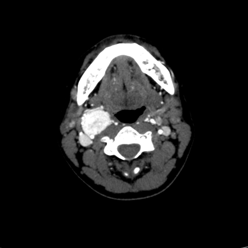 File:Carotid body tumor (Radiopaedia 39845-42300 B 41).jpg