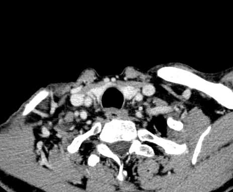 Carotid body tumor (Radiopaedia 61750-69757 Axial Post contrast 105).jpg