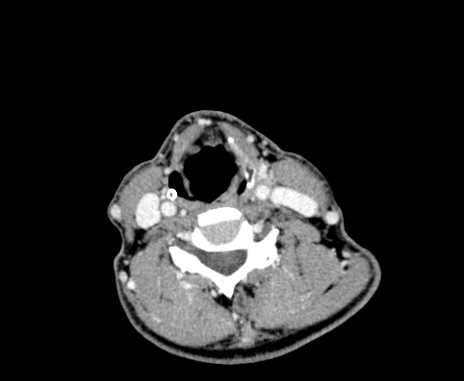 Carotid body tumor (Radiopaedia 61750-69757 Axial Post contrast 71).jpg