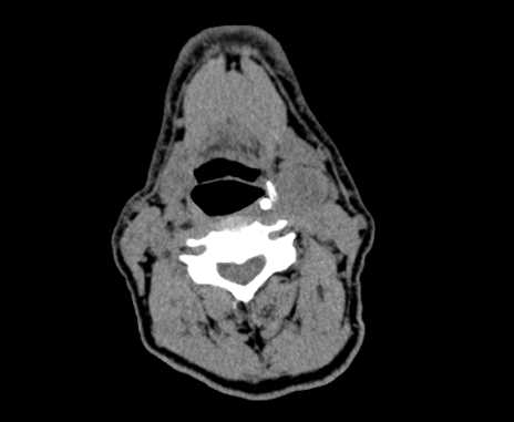 Carotid body tumor (Radiopaedia 61750-69757 Axial non-contrast 50).jpg