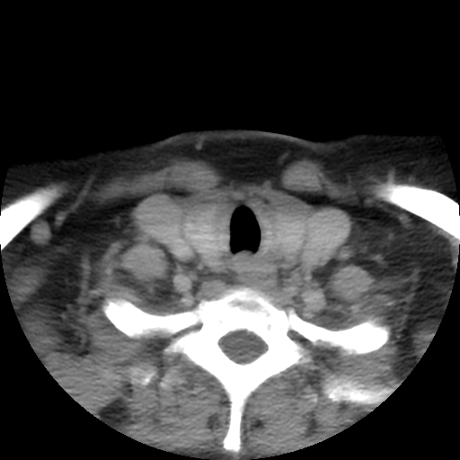 File:Carotid body tumor (paraganglioma) (Radiopaedia 38586-40729 A 63).jpg