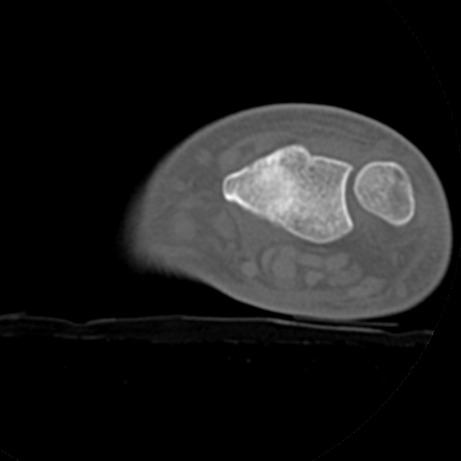 File:Carpo-metacarpal fracture-dislocations with hamatum split fracture (Radiopaedia 18482-18343 Axial bone window 30).jpg