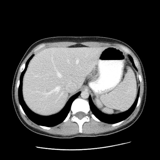 Castleman disease with fibrous pseudotumor in the abdomen (Radiopaedia 77296-89373 A 24).jpg