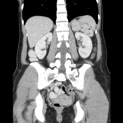 File:Castleman disease with fibrous pseudotumor in the abdomen (Radiopaedia 77296-89373 B 65).jpg