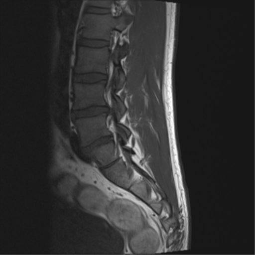File:Cauda equina syndrome (Radiopaedia 53615-59672 Axial T1 6).png