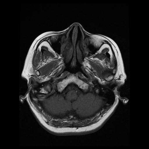 File:Cavernoma with developmental venous anomaly (Radiopaedia 22470-22507 B 3).jpg