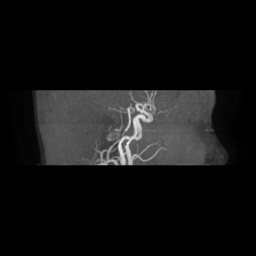 File:Cavernoma with developmental venous anomaly (Radiopaedia 22470-22507 MRA 18).jpg