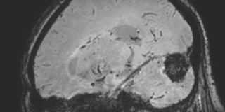 Cavernous hemangioma of the cerebellar falx (Radiopaedia 73025-83724 Sagittal BOLD 129).jpg
