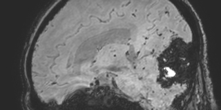 File:Cavernous hemangioma of the cerebellar falx (Radiopaedia 73025-83724 Sagittal BOLD 87).jpg
