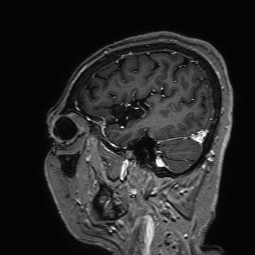 Cavernous hemangioma of the cerebellar falx (Radiopaedia 73025-83724 Sagittal T1 C+ 43).jpg