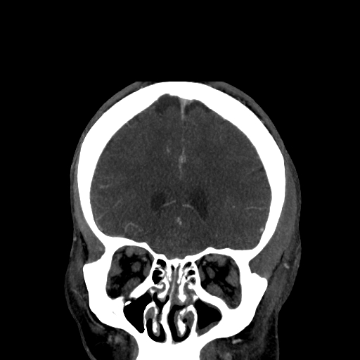 File:Cavernous sinus thrombosis (Radiopaedia 10619-11078 D 5).jpg