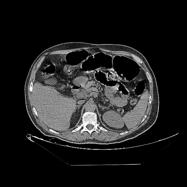 Cavitating bronchogenic carcinoma (Radiopaedia 44489-48162 Axial non-contrast 95).jpg