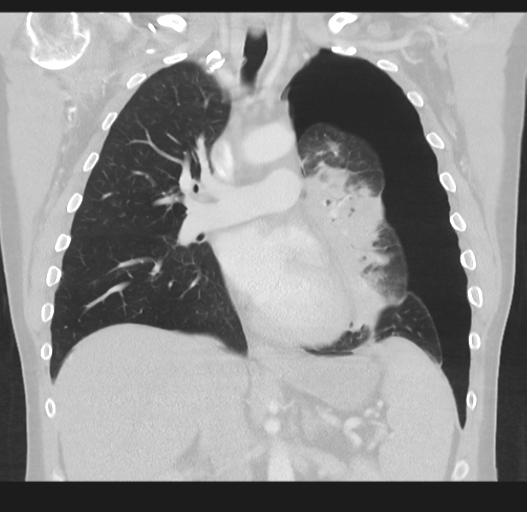 Cavitating pneumonia complicated by pneumothorax (Radiopaedia 48149-52994 Coronal lung window 30).png