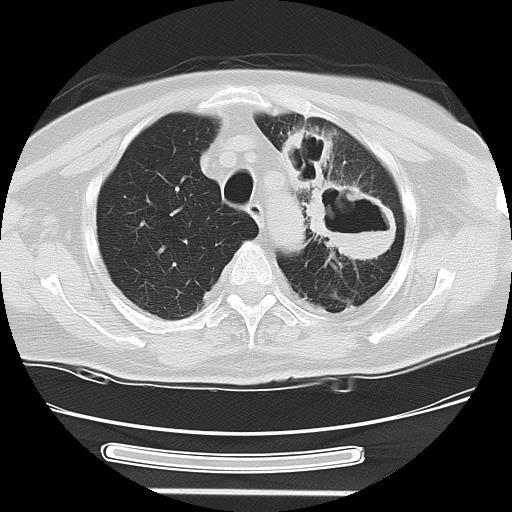 Cavitating pulmonary metastases (Radiopaedia 89545-106544 Axial lung window 14).jpg