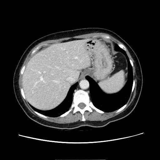 Cecal adenocarcinoma (Radiopaedia 75909-87331 A 21).jpg