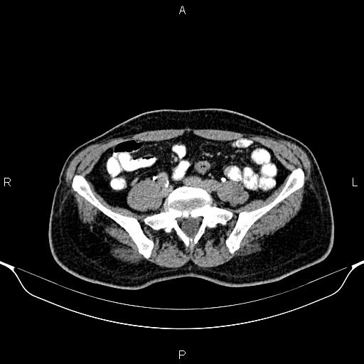 Cecal adenocarcinoma (Radiopaedia 85324-100916 Axial C+ delayed 68).jpg