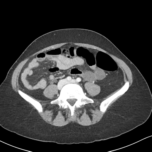 Cecal internal hernia through the foramen of Winslow (Radiopaedia 44820-48651 B 48).png