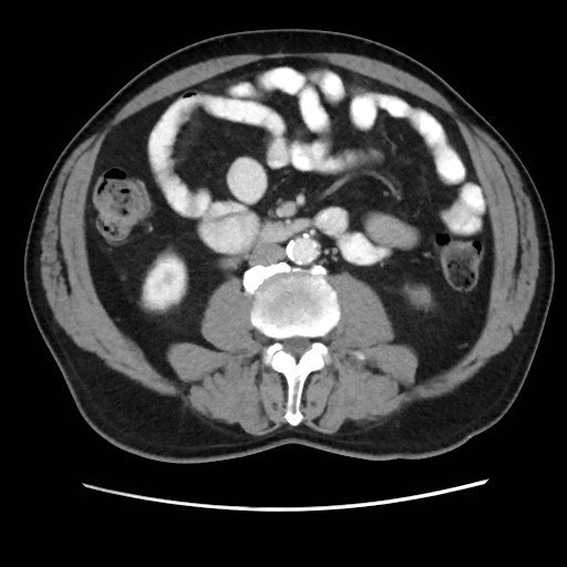 Cecal mass causing appendicitis (Radiopaedia 59207-66531 A 46).jpg
