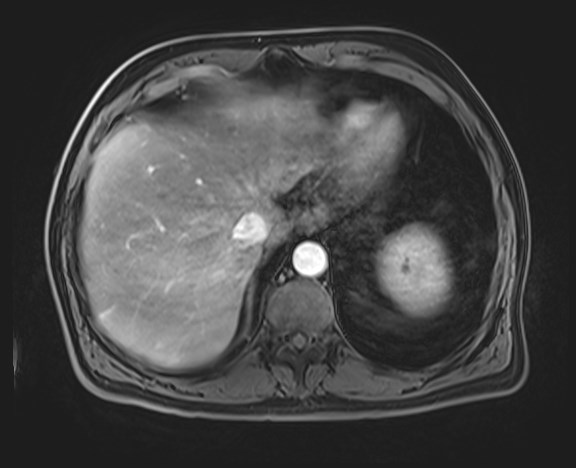 Cecal mass causing appendicitis (Radiopaedia 59207-66532 H 29).jpg
