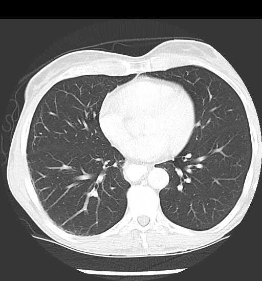 File:Cecal volvulus (Radiopaedia 48543-53513 Axial lung window 2).jpg