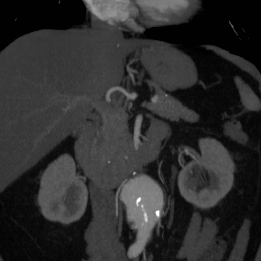 File:Celiac artery compression by the diaphragmatic crurae (Radiopaedia 31739-32666 B 3).jpg