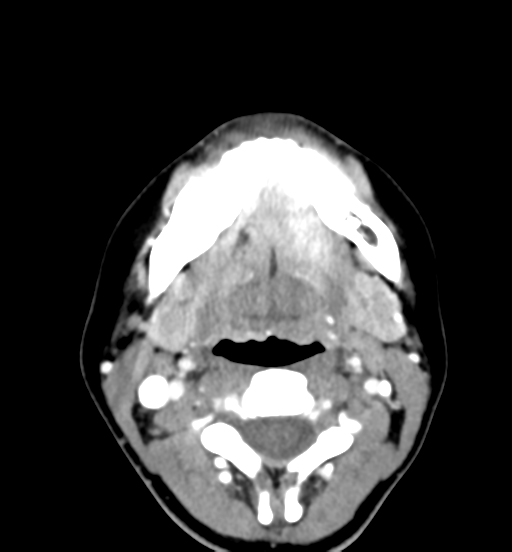 File:Cemento-ossifying fibroma (Radiopaedia 46243-50643 Axial C+ delayed 42).png