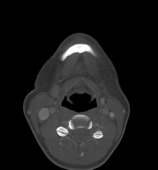 File:Cemento-ossifying fibroma (Radiopaedia 46243-50643 Axial bone window 50).png