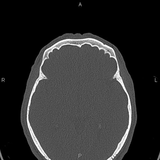 File:Central giant cell granuloma (Radiopaedia 83346-97761 Axial bone window 75).jpg