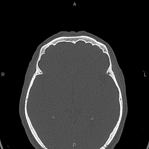 File:Central giant cell granuloma (Radiopaedia 83346-97761 Axial bone window 76).jpg