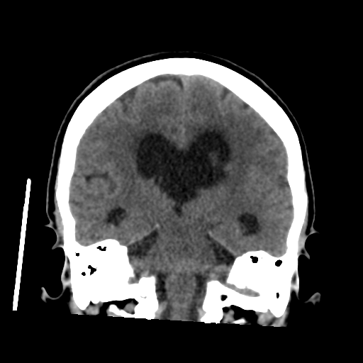 File:Central neurocytoma (Radiopaedia 65317-74346 Coronal non-contrast 35).png