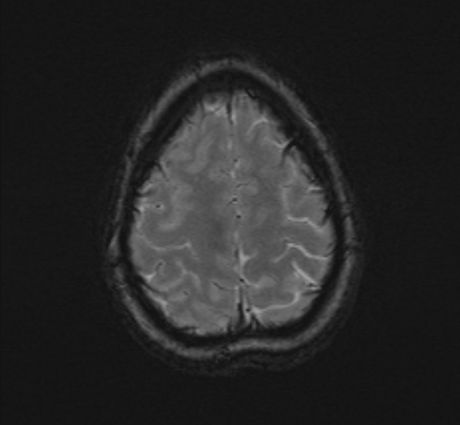 Central neurocytoma (Radiopaedia 70263-80336 Axial SWI 52).jpg
