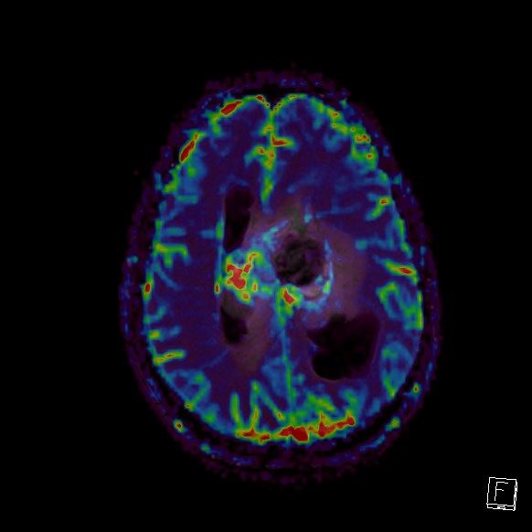 Central neurocytoma (Radiopaedia 84497-99872 Axial Perfusion 106).jpg