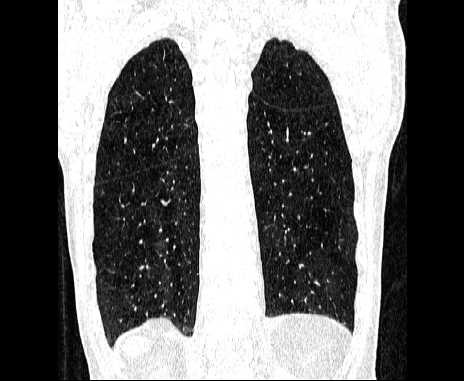 Centrilobular pulmonary emphysema (Radiopaedia 62468-70718 Coronal lung window 59).jpg