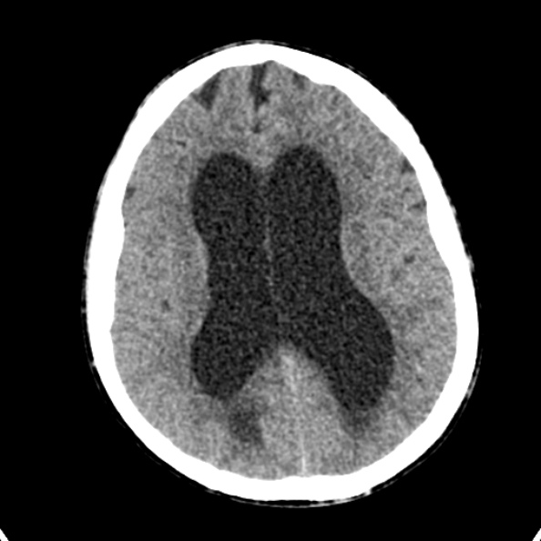 Cerebellar abscess secondary to mastoiditis (Radiopaedia 26284-26412 Axial non-contrast 97).jpg