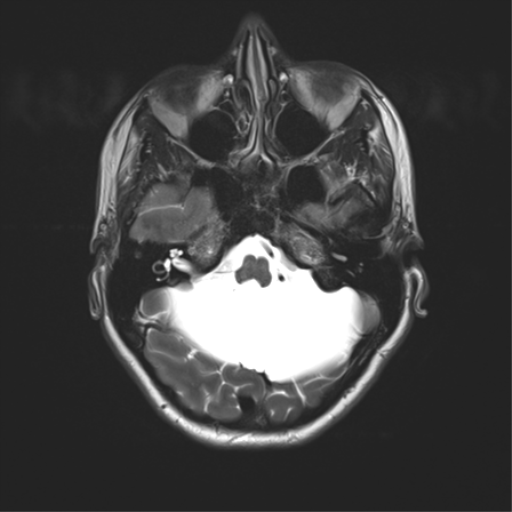 File:Cerebellar agenesis with hypoplastic pons (pontocerebellar hypoplasia) (Radiopaedia 57224-64138 Axial T2 11).png