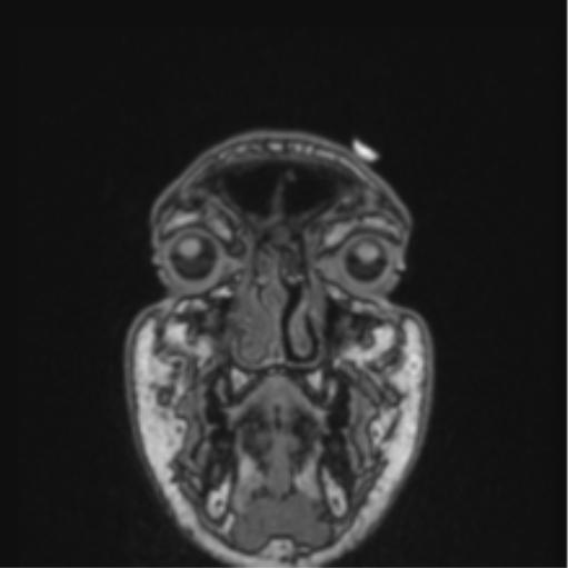 File:Cerebellar hemangioblastomas and pituitary adenoma (Radiopaedia 85490-101176 Coronal T1 86).png