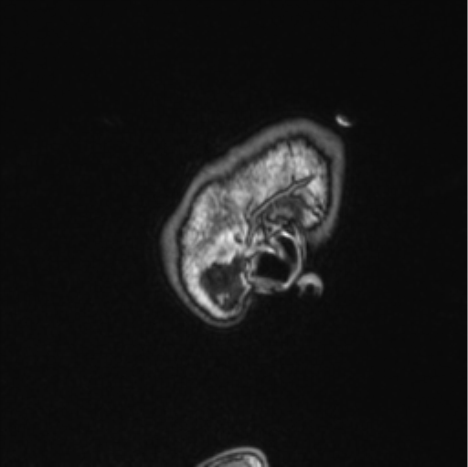 Cerebellar hemangioblastomas and pituitary adenoma (Radiopaedia 85490-101176 Sagittal T1 89).png