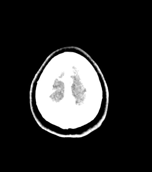 Cerebellar metastases - colorectal adenocarcinoma (Radiopaedia 40947-43652 Axial C+ 61).png