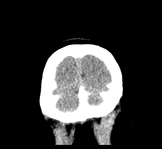 Cerebellar metastases - colorectal adenocarcinoma (Radiopaedia 40947-43652 Coronal non-contrast 87).png