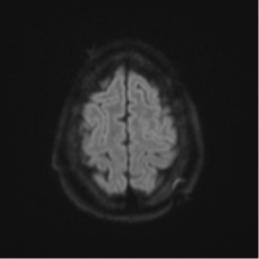 Cerebellar metastasis (Radiopaedia 51137-56765 Axial DWI 52).png