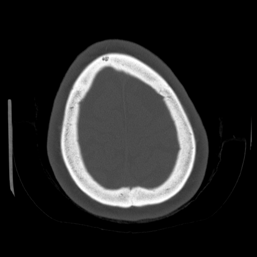 Cerebellar metastasis (cystic appearance) (Radiopaedia 41395-44258 Axial bone window 62).png
