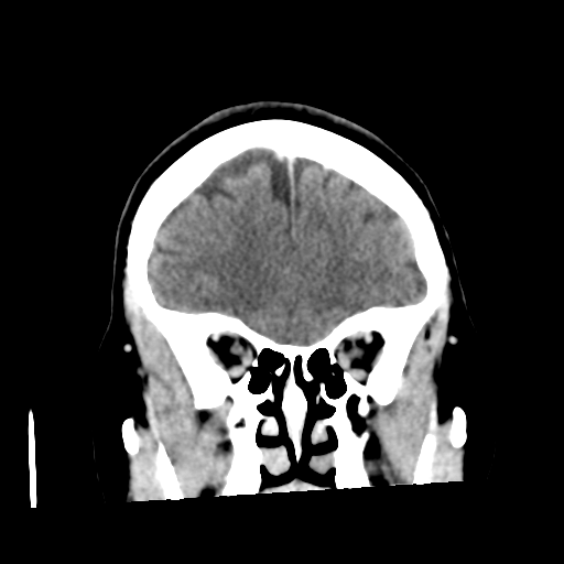 Cerebellar metastasis (cystic appearance) (Radiopaedia 41395-44258 D 18).png