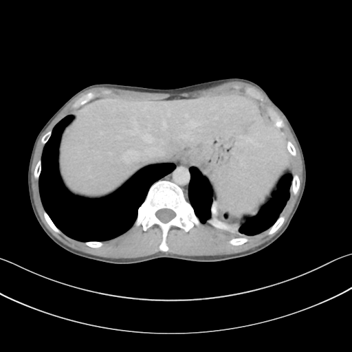 Cerebellar metastasis - adenocarcinoma lung (Radiopaedia 63184-71717 Axial C+ delayed 61).png