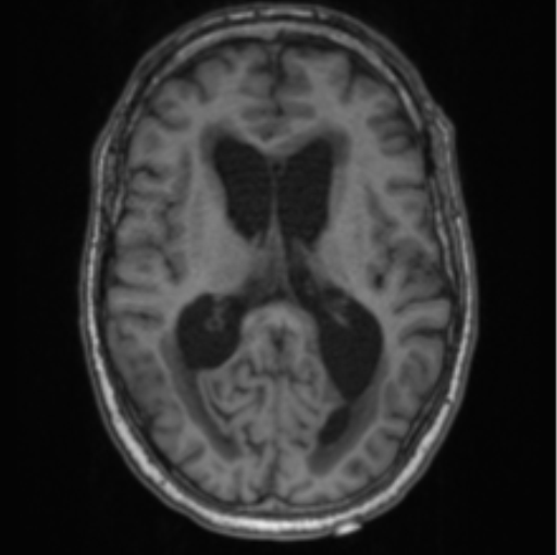 Cerebellar metastasis from lung adenocarcinoma (Radiopaedia 86690-102829 Axial T1 45).png