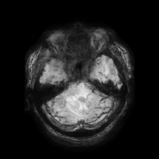 Cerebellar metastasis of pulmonary adenocarcinoma, cavernous venous malformation, and developmental venous anomaly (Radiopaedia 85827-101661 Axial SWI 50).jpg
