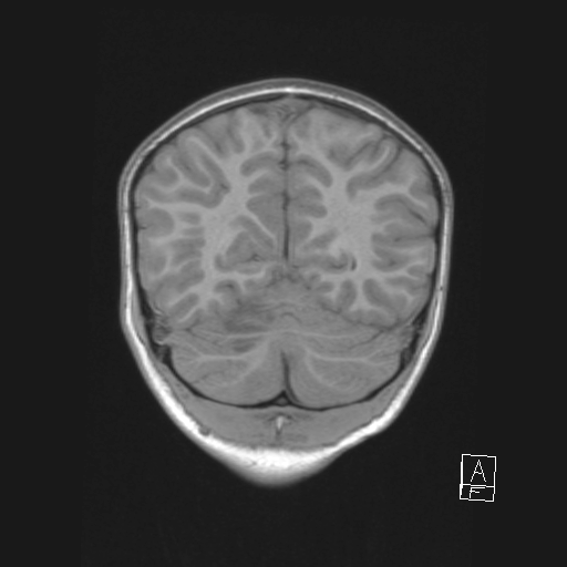 Cerebellar stroke (Radiopaedia 32202-33150 Coronal T1 47).png
