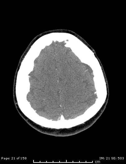 Cerebellar strokes due to intracranial giant cell arteritis (Radiopaedia 68799-78510 CT angiogram 21).jpg
